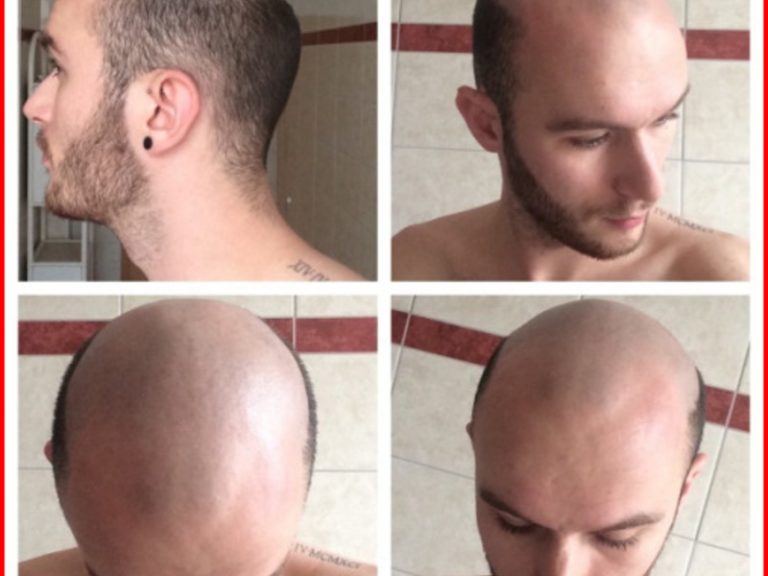 Teenage Male Pattern Baldness - Best Kids Hairstyle