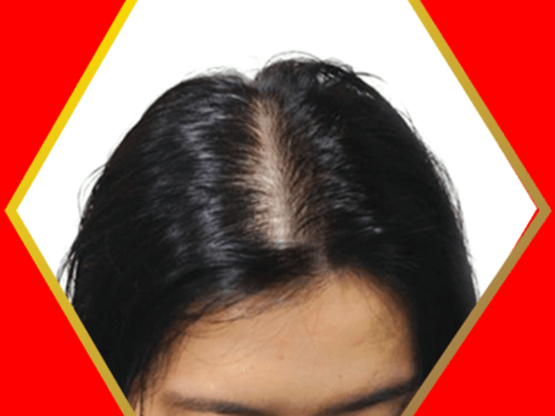 Hair Fall Causes In Female